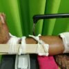 Pemuda Sirapit Dihadang dan Disiksa Gerombolan Preman, Urat Kaki Putus Dipotong