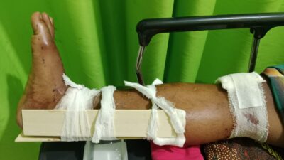Pemuda Sirapit Dihadang dan Disiksa Gerombolan Preman, Urat Kaki Putus Dipotong